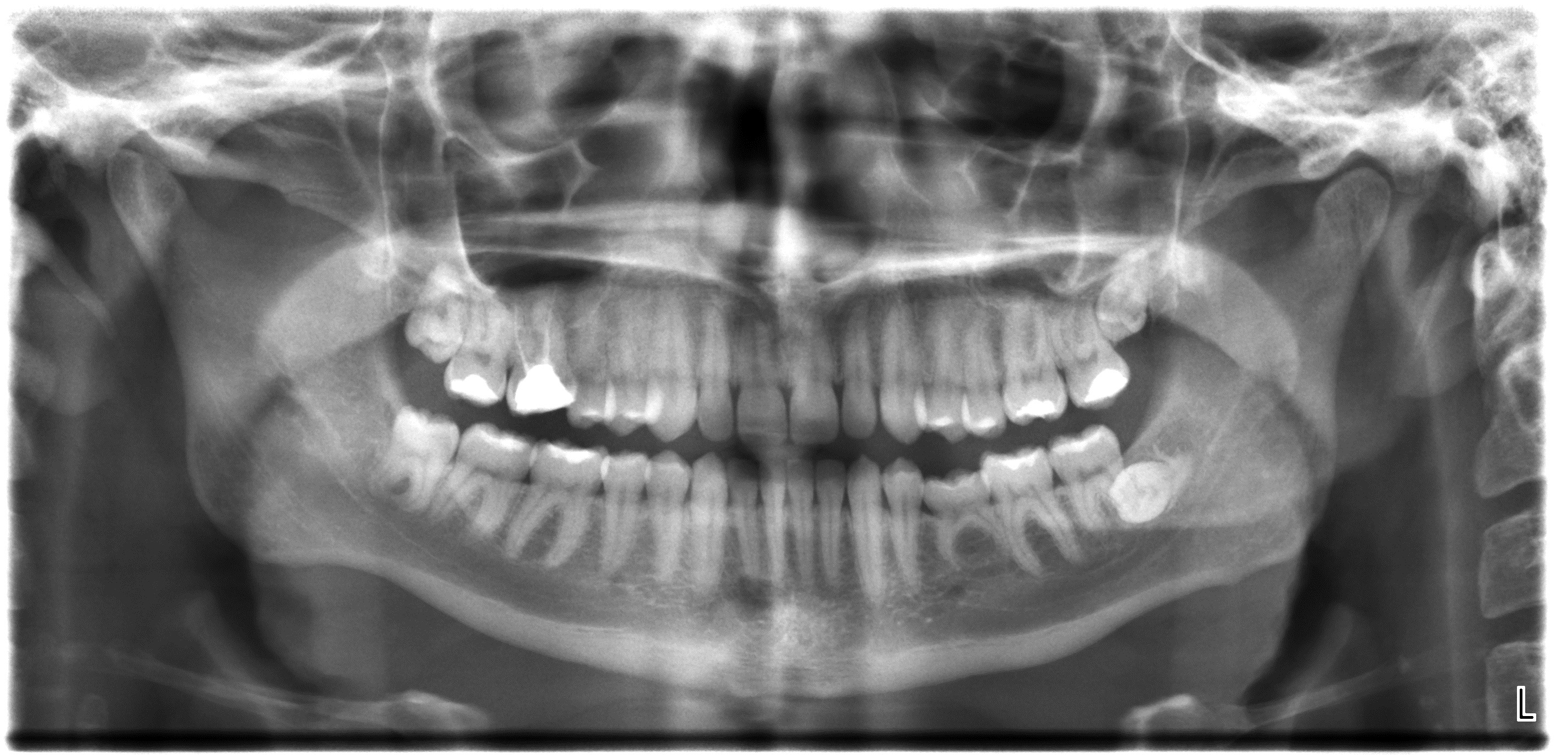 Demo panoramic radiograph